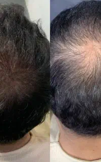 میکرو اسکالپ جایگزین کاشت مو و پرحجمی مو