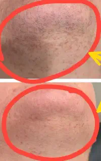حذف دائمی موهای زائد بدون لیزر در خانه