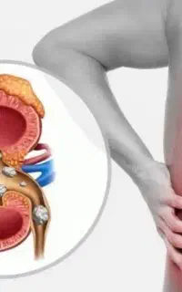 معجون طلایی ،درمان سریعتر از جراحی برای سنگ کلیه