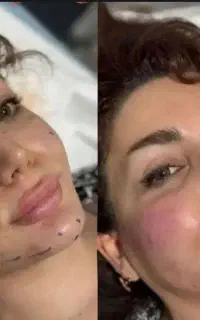 آفر ویژه فول فیس فیلر بینی خط خنده بوتاکس فیلربادی