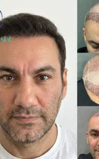 نژا کاشت مجموعه تخصصی کاشت مو و ابرو از سال 1383