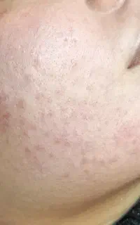 الگاپیل مزونیدلینگ