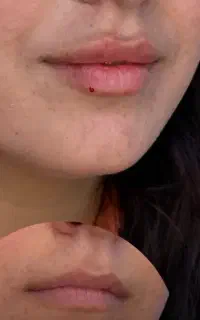 فیلر ژل بوتاکس آنزیم برداشت خال فشیال