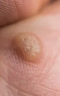 رهایی از دغدغه‌های پوستی و بازگشت به زندگی عادی