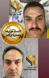 کاشت مو VIP برای آقایان و بانوان