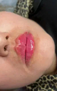 تزریق ژل و بوتاکس