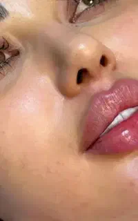 جشنواره تخصصی ژل فیلر هایفو بایوفیلر در کلینیک