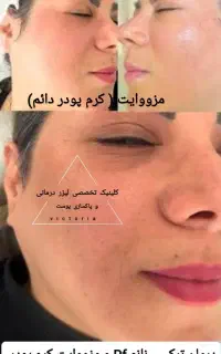 لیزرریموتاتو خالکوبی ابروبدن آقاخانم(تعرفه دولتی)