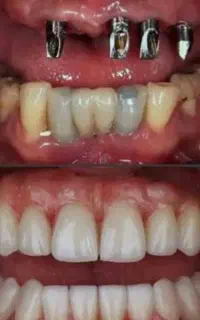 ایمپلنت تخصصی . اقساطی . گرمسار