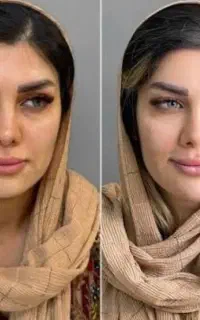 پرسینگ بوتاکس ژل