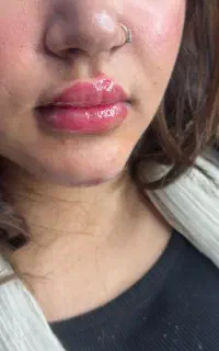 خدمات فیلر بوتاکس پی ارپی مزونیدلینگ