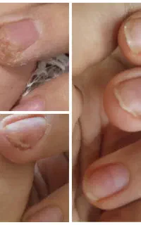 برداشتن خال وزگیل جوانسازی پاک کردن تاتو صورت وبدن