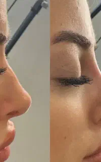 ژل و بوتاکس