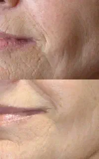 بوتاکس طبیعی صورت رفع جای جوش