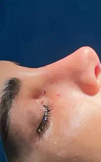 آف ویژه عمل بینی 26میلیون