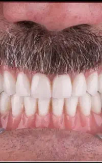 دندانسازی متحرک