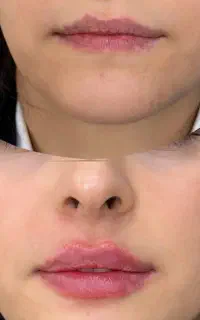 مطب زیبایی، ژل و بوتاکس