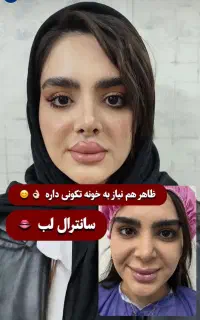 جراحی زیبایی/پلک بالا/پایین/سانترال لب/بوکال فت
