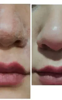 فشیال،مزونیدلینگ،پلکسر