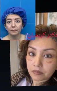 پایان خط اخم و افتادگی صورت با لیفت  اندوسکوپ