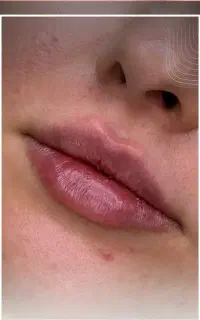 فیلر لب روسی و طبیعی