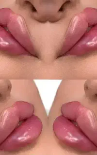 تزریق ژل بوتاکس فیلر لیزر فشیال در کلینیک زیبایی