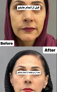 هایفو کامل در مطب پزشک تا ۲۹ خرداد ۳/۲۰۰