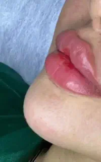 جشنواره فیلر  صورت لب گونه چانه از سی سی ۸۵۰هزار
