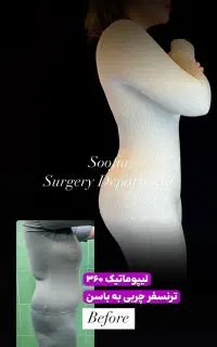 لیپو ابدو تزریق پیکرتراشی مامو لیفت و پروتز سینه
