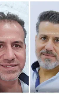 کاشت مو با تعرفه ی دولتی