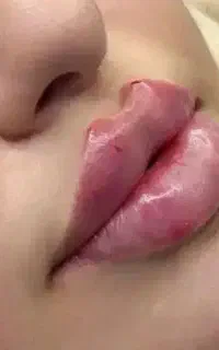 مدل ژل.و فیلرو بو تاکس موادآمریکایی وارداتی