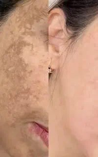 بلیچینگ بیکینی و تمام نواحی بدن و پاک کردن تاتو