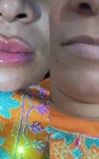 ژل و بوتاکس
