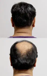 با این درمان موهاتو باید دم اسبی ببندی