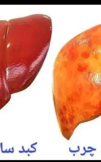 بهبود وپاکسازی کبد چرب
