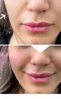 فیلر،بوتاکس