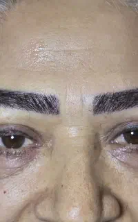 کاشت ابرو و بلفاروپلاستی