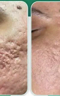 تخفیف شگفت انگیزلیزرco2 فرکشنال جوانسازروشنکننده