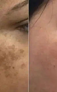 جشنواره تخفیف ویژه حذف خال،لک،ککومک پوستی،تتو ابرو