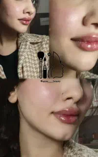 ژل،فیلر، بوتاکس جوانساز مزوژل