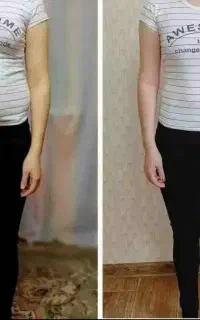 تنها و بهترین روش لاغری ونتیجه قطعی باکرایولیپولیز
