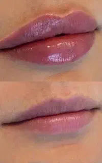 آموزش فیلر و مزو تراپی حضوری و مجازی