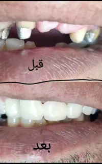 انجام کلیه درمانهای دندانپزشکی با تعرفه ۱۴۰۴