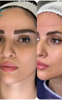 کاشت ابرو ، میکرو کاشت ، زعفرانیه پالادیوم