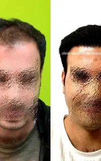 کلینیک تخصصی کاشت مو دکتر امیر رضا درخشان