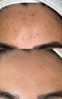 پاکسازی پوست ( فیشال درمانی فقط و فقط ۶۵۰هزارتومن)
