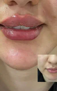 فیلرلب وبوتاکس