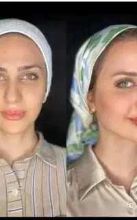 ژل بوتاکس فیلر چشم لب گونه مزوتراپی فشیال خانم اقا