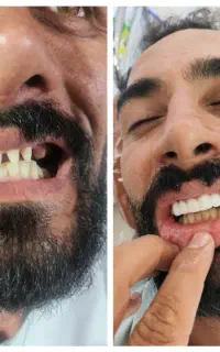 ترمیم دندان 900/000روکش سرامیکی 3/300/000