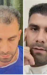 کاشت مو VIP شیراز در یزد،با ۲۱ سال سابقه درخشان